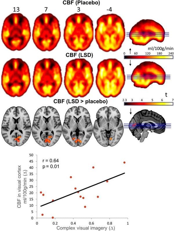 Modélisation des effets du LSD par neuroimagerie